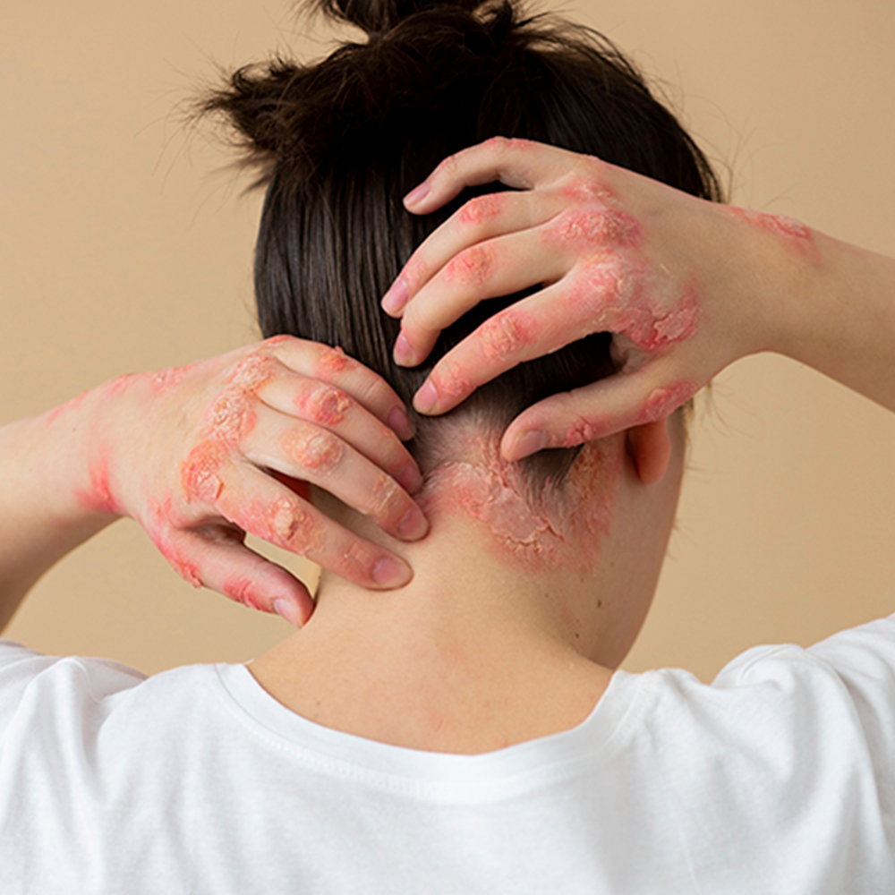 Terapia Celular de la Psoriasis